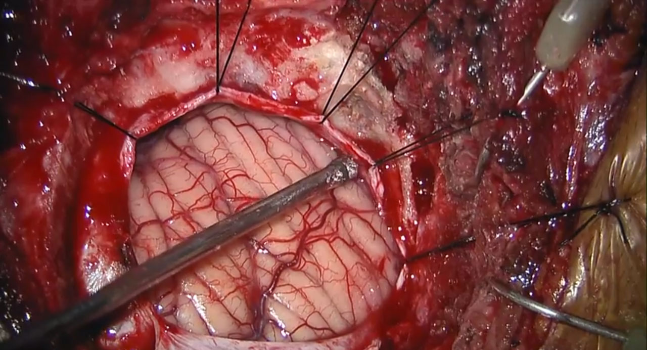 Neurological Surgery in HD – Med X Change