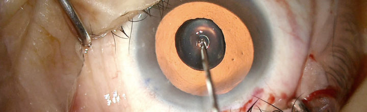 4K Medical Video Cataract Case