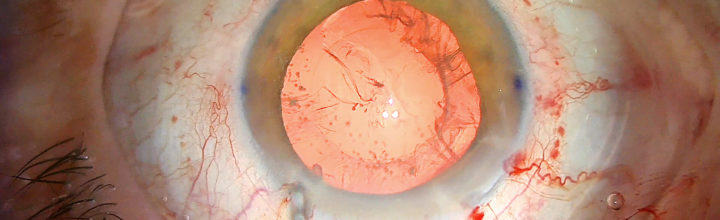 4K Medical Video Cataract Case 2